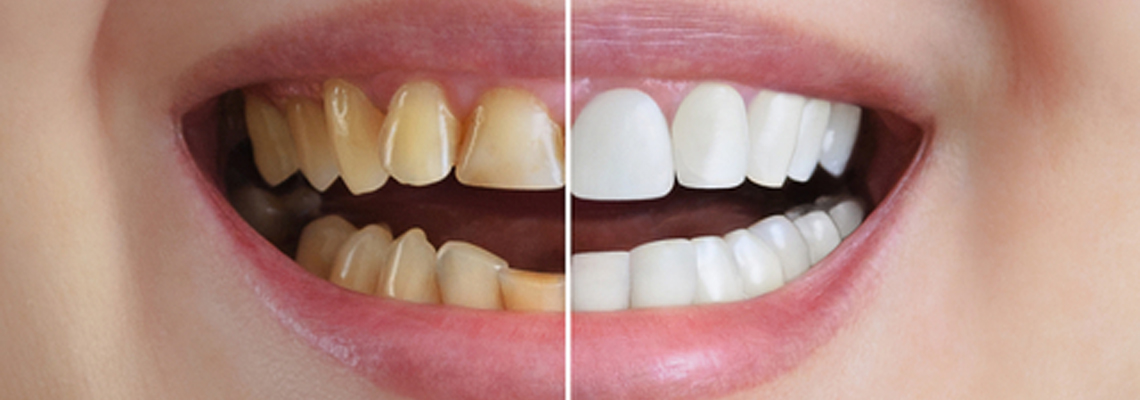 Full Mouth Rehabilitation